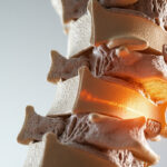 Comprendre la spondylodiscarthrose : symptômes et traitements